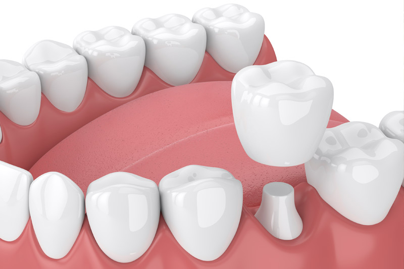 Dental Crowns in Wahoo